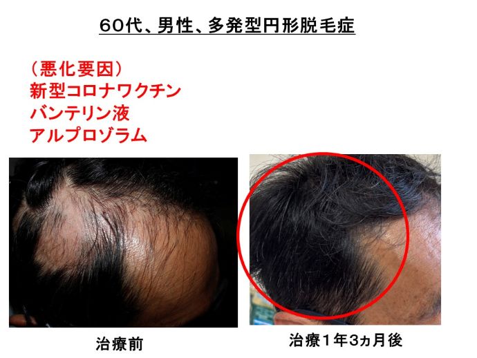 円形脱毛症　病院